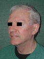 SMAS facelift