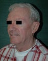 SMAS facelift