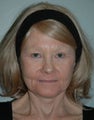 SMAS facelift