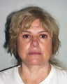 SMAS facelift