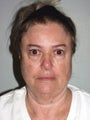 SMAS facelift
