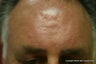 Scar removal