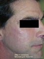 Scar removal