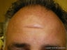 Scar removal
