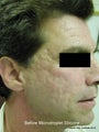 Scar removal
