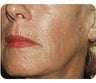 Sculptra