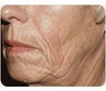 Sculptra