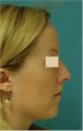 Septoplasty