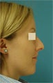 Septoplasty