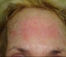 Skin tightening