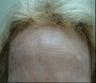 Skin tightening