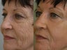 Skin rejuvenation