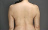 Smart Lipo
