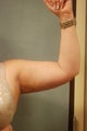 Smart Lipo