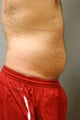 Smart Lipo