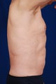 Smart Lipo