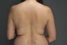 Smart Lipo