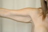 Smart Lipo