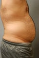 Smart Lipo