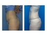 SmartLipo MPX