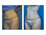 SmartLipo MPX