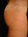 Stretch Marks Treatment