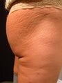 Stretch Marks Treatment