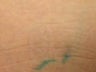 Tattoo removal