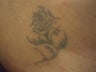 Tattoo removal