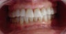 Teeth whitening