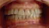 Teeth whitening