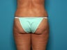 Tumescent liposuction
