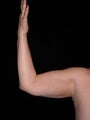 Tumescent liposuction