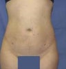 Tumescent liposuction