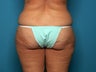 Tumescent liposuction