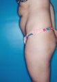 Tumescent liposuction