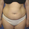 Tumescent liposuction
