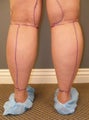 Tumescent liposuction