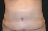 Tummy tuck