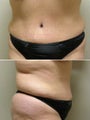 Tummy tuck