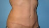 Tummy tuck