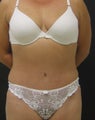 Tummy tuck