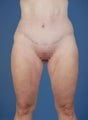 Tummy tuck
