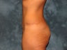 Tummy tuck