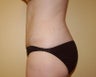 Tummy tuck
