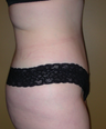 Tummy tuck
