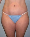 Tummy tuck