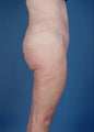 Tummy tuck