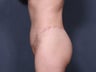 Tummy tuck