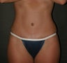 Tummy tuck